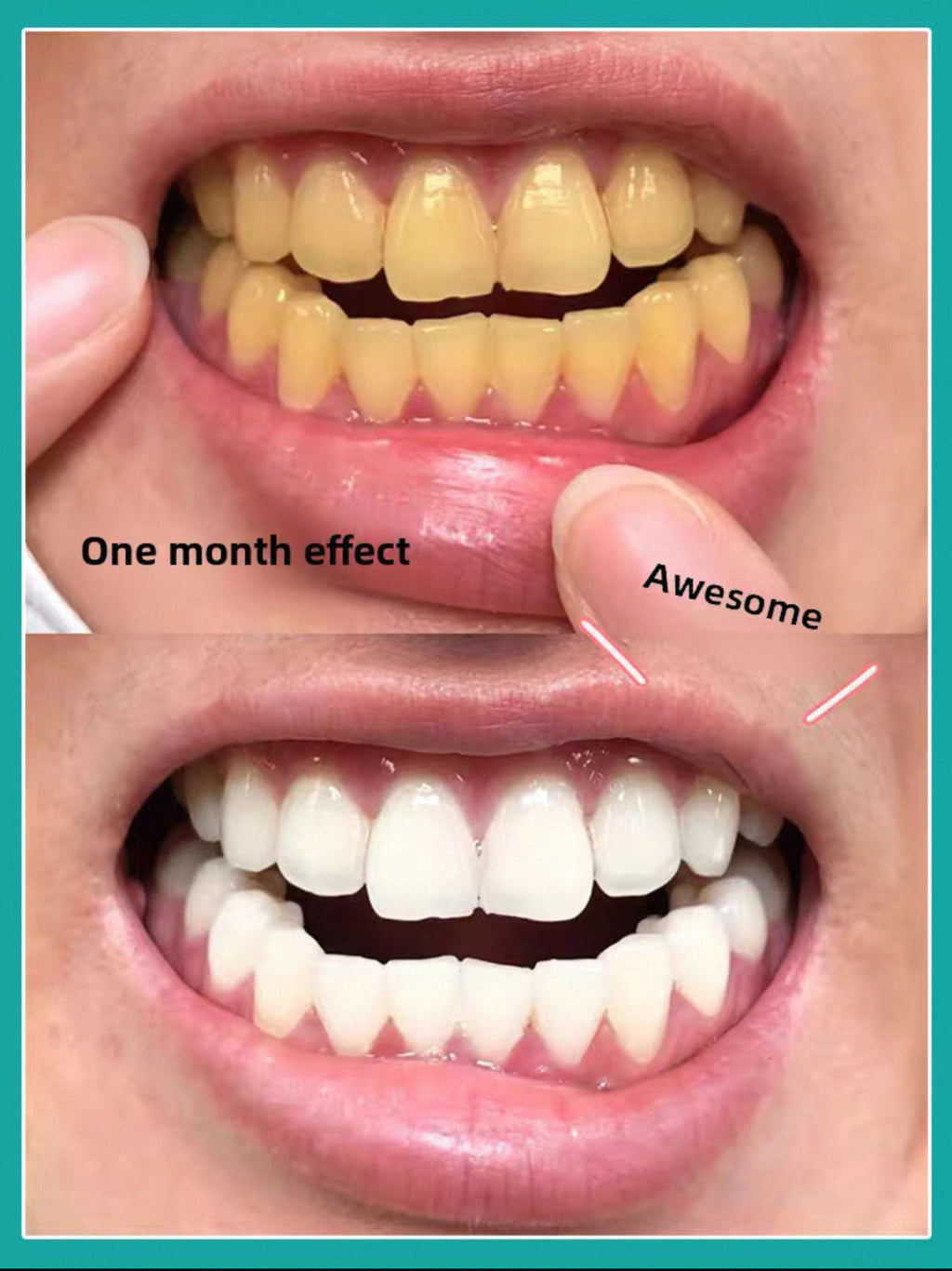 Instant Teeth Whitening Patches with White Moonlight Dental Membrane Gel